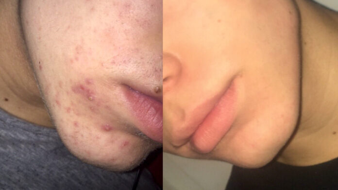 Are you suffering from acne, you should take Retin-A Micros