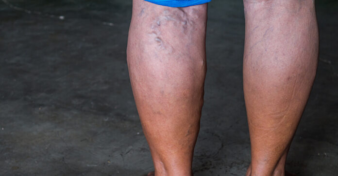 What Are Varicose Veins, and Can They Be Harmful?
